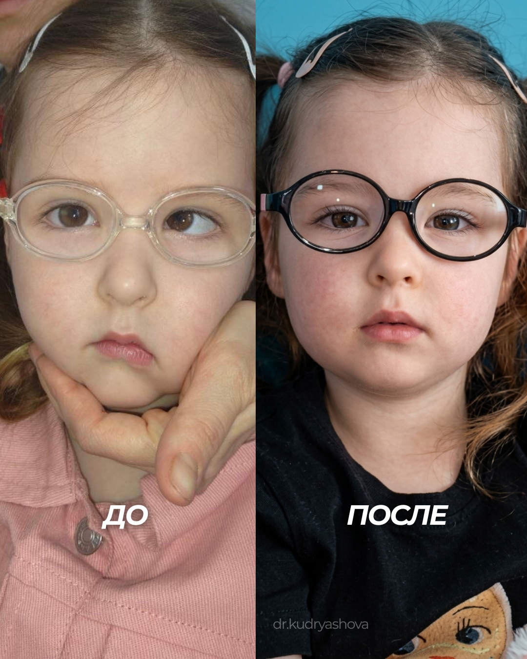 Результат хирургии косоглазия